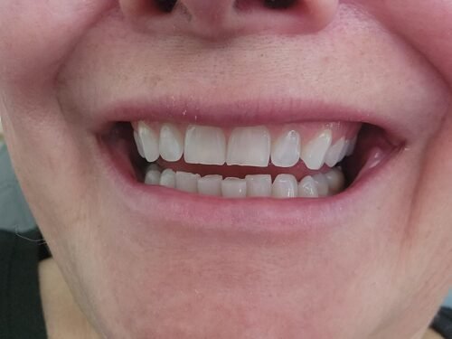 Aquasonic Black Series Ultra Whitening Toothbrush – ADA Accepted Electric Toothbrush- 8 Brush Heads & Travel Case – 40.000 VPM Electric Motor & Wireless Charging - 4 Modes w Smart Timer photo review